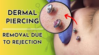 Dermal Piercings | Removal (Due to Rejection) 💎❌