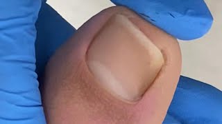 Surprise! large ingrown nails【Xue Yidao】