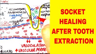 Socket Healing after Tooth Extraction