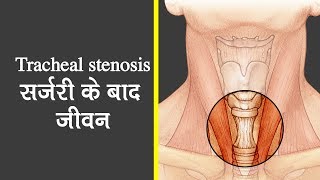Tracheal Stenosis सर्जरी के बाद जीवन | Life after surgery Dr. Arvind Kumar [+91-9773635888]