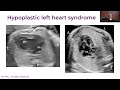 Fetal Diagnosis - Jacqueline Weinberg, MD