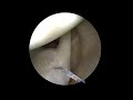 spalla slap lesion shuttleing prof. francesco franceschi ortopedico spalla roma