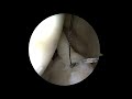 spalla slap lesion shuttleing prof. francesco franceschi ortopedico spalla roma