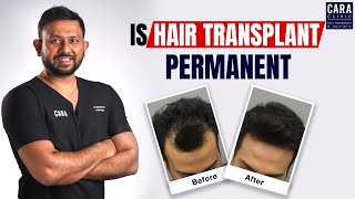 Is hair transplant permanent to treat androgenic alopecia ?