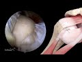 combined loop ‘n’ tack™ biceps tenodesis and upper border subscapularis repair