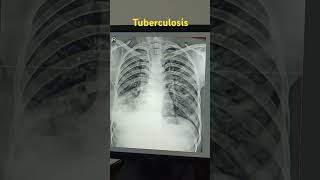 Xray Chest pa tuberculosis BVM both lung fild