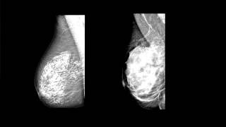How Breast Structure Changes Over Time: Dr. Laszlo Tabar Explains