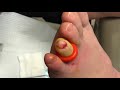 pediatric toenail removal