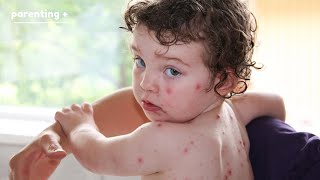 What To Do If Your Child Has Chicken Pox