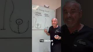 Lollipop vs Anchor Breast Lift: Which Technique Is Right for You?