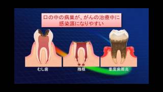 「徳島大学病院」TVいきいきらいふ第60回がん治療と口腔ケア