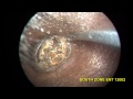 impacted ear wax stony hard removal