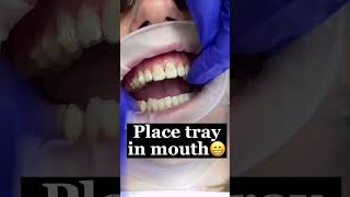 Invisalign Process Start to Finish🦷