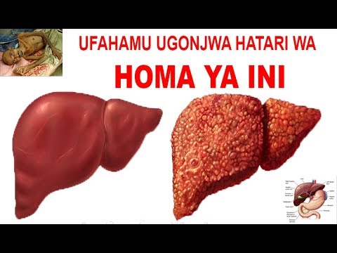 HOMA YA INI UGONJWA HATARI ZAIDI | MASANJA TV - YouTube