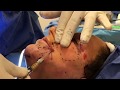 Facial Fat Transfer Fill | Dr. Madnani