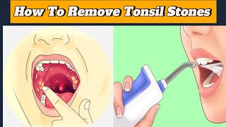 “How to Remove Tonsil Stones at Home | Best Methods for Tonsil Stone Removal!\