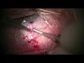 XEN Glaucoma MIGS - External Conjunctival Cut Down Approach - I Paul Singh