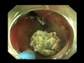 successful endoscopic closure of chronic nonmalignant tracheoesophageal fistula