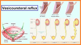 vesicoureteral reflux