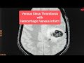 Venous Sinus Thrombosis with Hemorrhagic Venous Infarct