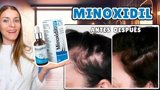 CÓMO SE USA EL MINOXIDIL |  no uses minoxidil sin ver este video