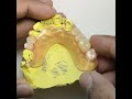 Flexible partial Denture by Prof Dental Lab w 25 years experience,Online Order:www.rosenthaldent.com