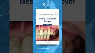 [K Family Dentistry] Mesial Cantilever Bridge Tooth #12, 13, 14 Case Study #dentalbridge