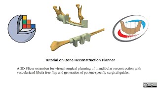 Mandible reconstruction | 3D Slicer Tutorial