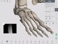 metatarsal fractures complete anatomy