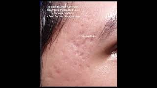 เทคนิครักษาหลุมสิวลึกขอบชัด Deep Boxcar \u0026 Linear Acne Scar: Picosecond Laser + Subcision + DFA