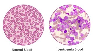 Leukemia #leukemia #bloodcells #cancer #blood #children #symptoms #genetic #fever #chills