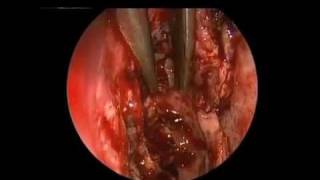 Endoscopic Endonasal Repair of Spontaneous CSF Fistulae