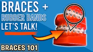 BRACES 101: When Do You Have To Wear RUBBER BANDS With BRACES?! | Treatment Minute Talk!