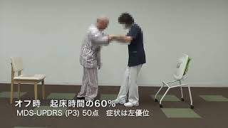 ウェアリングオフと歩行障害（集束超音波治療による淡蒼球凝固術症例）