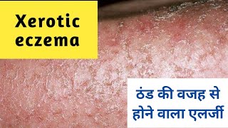 Asteatotic Eczema : Xerotic Eczema ठंड की वजह से होने वाला एलर्जी Dry winter allergy #dermatitis