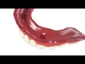 locator abutment overdenture chairside pick up using existing denture