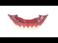 locator abutment overdenture chairside pick up using existing denture