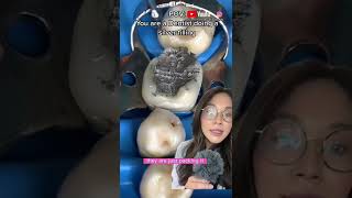 Dentist does a silver filling. #filling #cavity #silverfilling #dentist