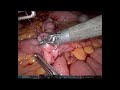 robotic ileocolic intracorporeal anastomosis unedited right hemicolectomy