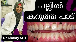 BLACK STAIN (COLOR) on TEETH: Reasons and Treatments|| പല്ലിലെ കറുത്ത പാടുകള്‍ എന്താണ്?| Dr SHEMY MR