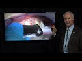 creation of gingival pontic receptor sites dental minute with steven t. cutbirth dds