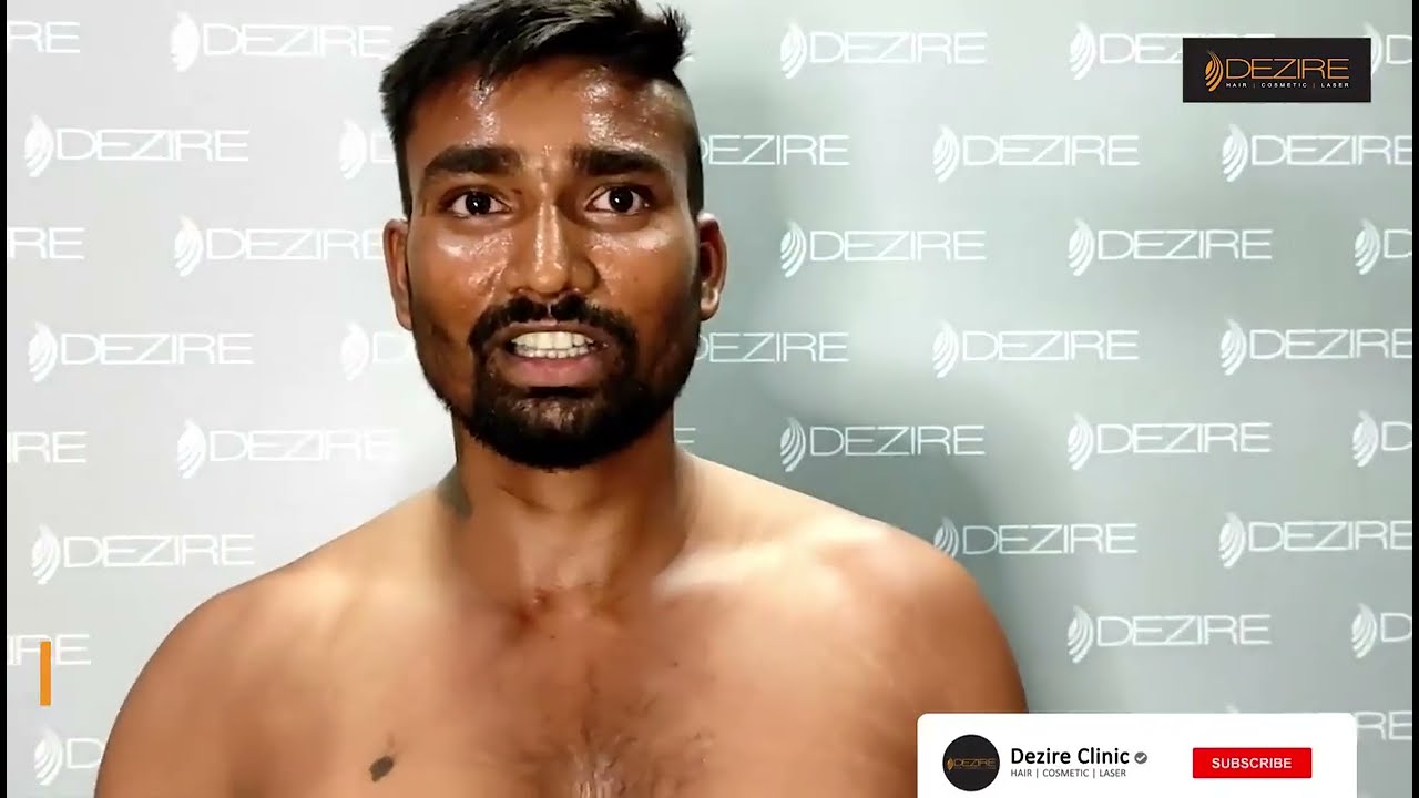 Grade 2 Gynecomastia Surgery Result - YouTube