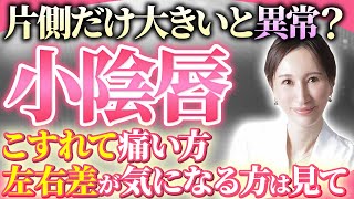 片側だけ小陰唇が大きいのはおかしい？左右差は誰にでもあるの？医師が徹底解説【婦人科形成】