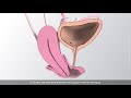 Vaginal hysterectomy