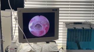 Inside Urology: Urethral Stricture Disease