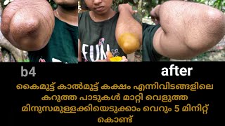 how to remove elbows dark spots | കൈമുട്ട് കാൽമുട്ട് കക്ഷം എന്നിവിടങ്ങളിലെ കറുത്ത പാടുകൾ മാറ്റാം