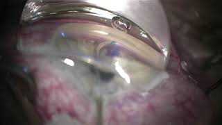 MIGS - Stand alone viscodilation and otomy creation with the OMNI Device-  I. Paul Singh, MD