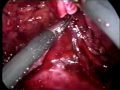 laparosopic retroperitoneal pyeloplasty by dr dinesh patel