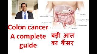 Colon cancer in Hindi. Large Bowel, large intestine cancer. Symptoms, treatment, Dr Vikas Singla.