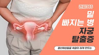 밑 빠지는 병, 자궁탈출증 [TBC클리닉건강365]